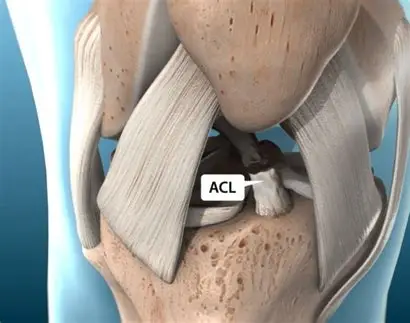 All-Inside Anterior Cruciate Ligament Reconstruction: A Minimally Invasive Surgical Innovation